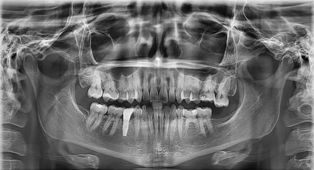 Radiografia Panorâmica
