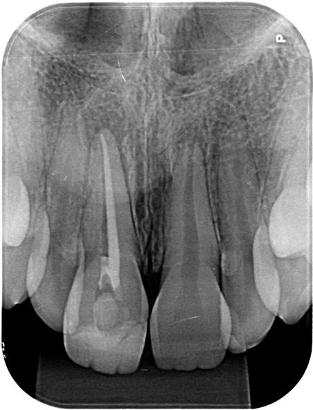 Radiografia Periapical