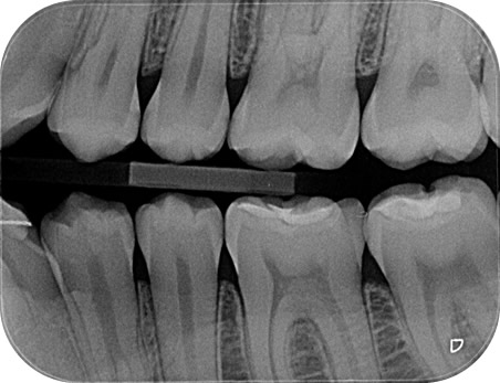 Radiografia interproximal