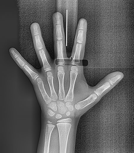 carpal